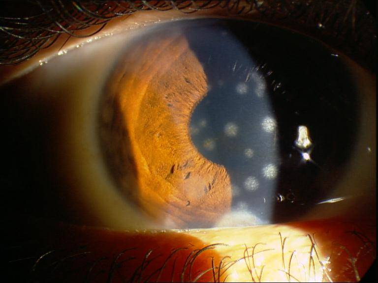 Кератит глаз — симптомы и лечение, фото, причины возникновения у взрослых, у детей