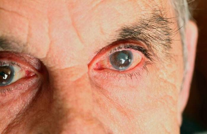 Методы лечения глаукомы у пожилых людей oculistic.ru
методы лечения глаукомы у пожилых людей