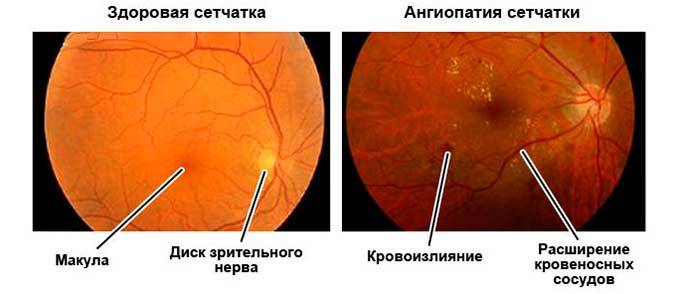 Ангиопатия сетчатки глаза - что это такое, симптомы и лечение