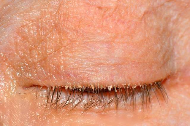 Особенности заболевания глаз блефарит: как лечить недуг