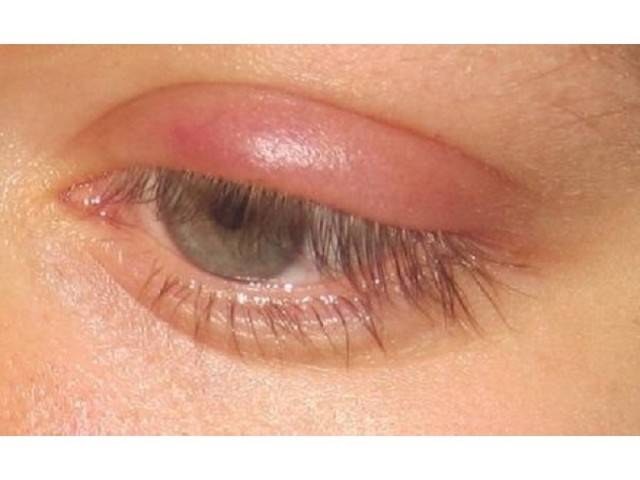 Внутренний ячмень на глазу: как лечить, правильное лечение пораженного внутри века, сложно ли вылечить заболевание