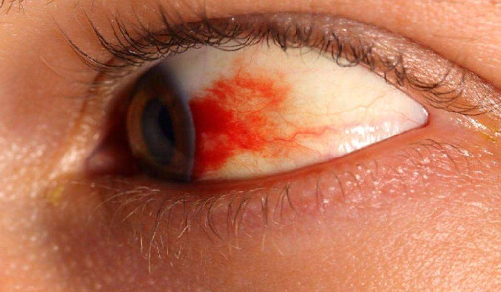 Белки глаз красные: причины, лечение у взрослых и детей, сопутствующие симптомы (красные прожилки, боль), последствия