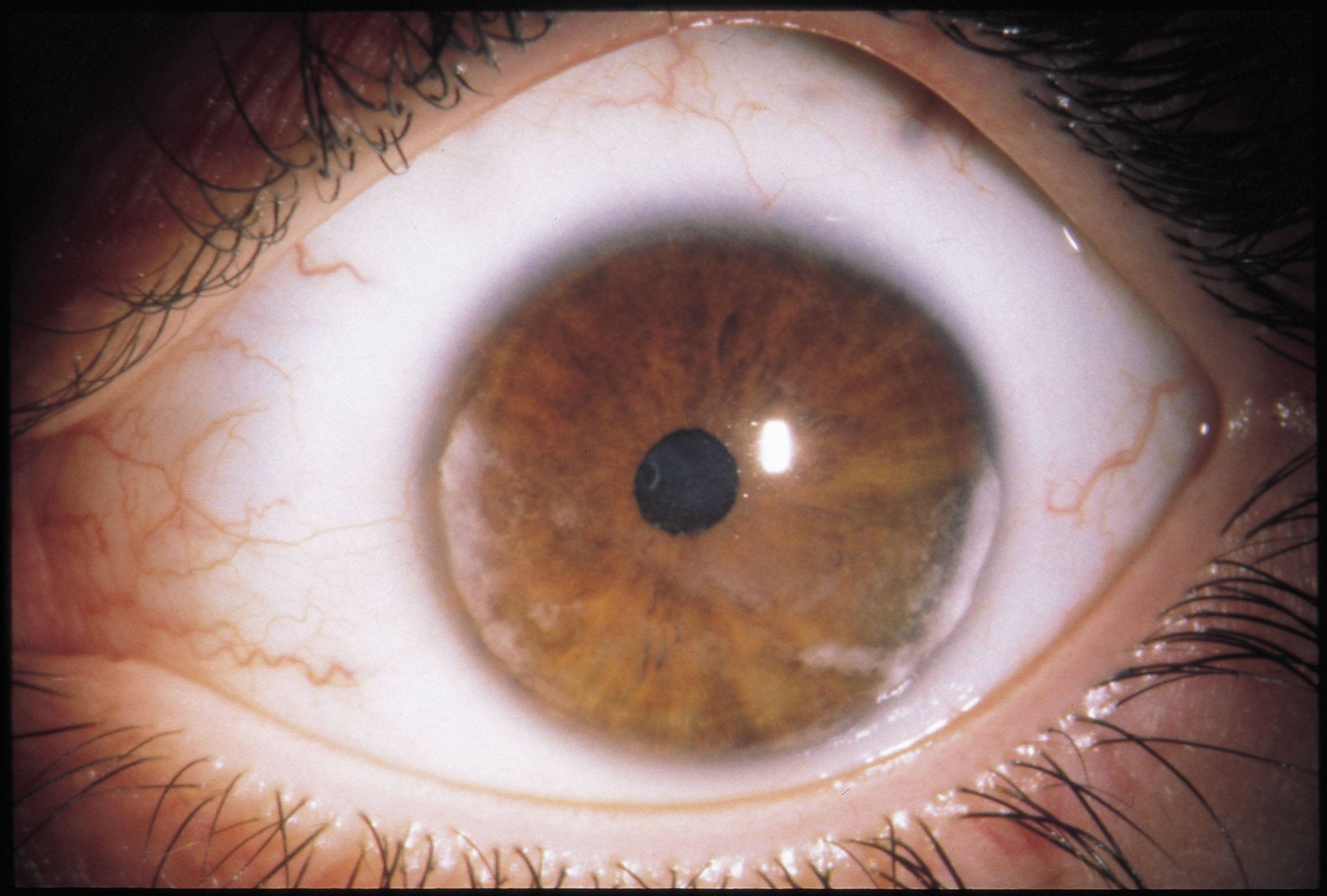 Причины, симптомы и лечение иридоциклита глаз