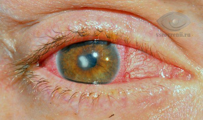 Язва роговицы глаза - лечение - vrachdo