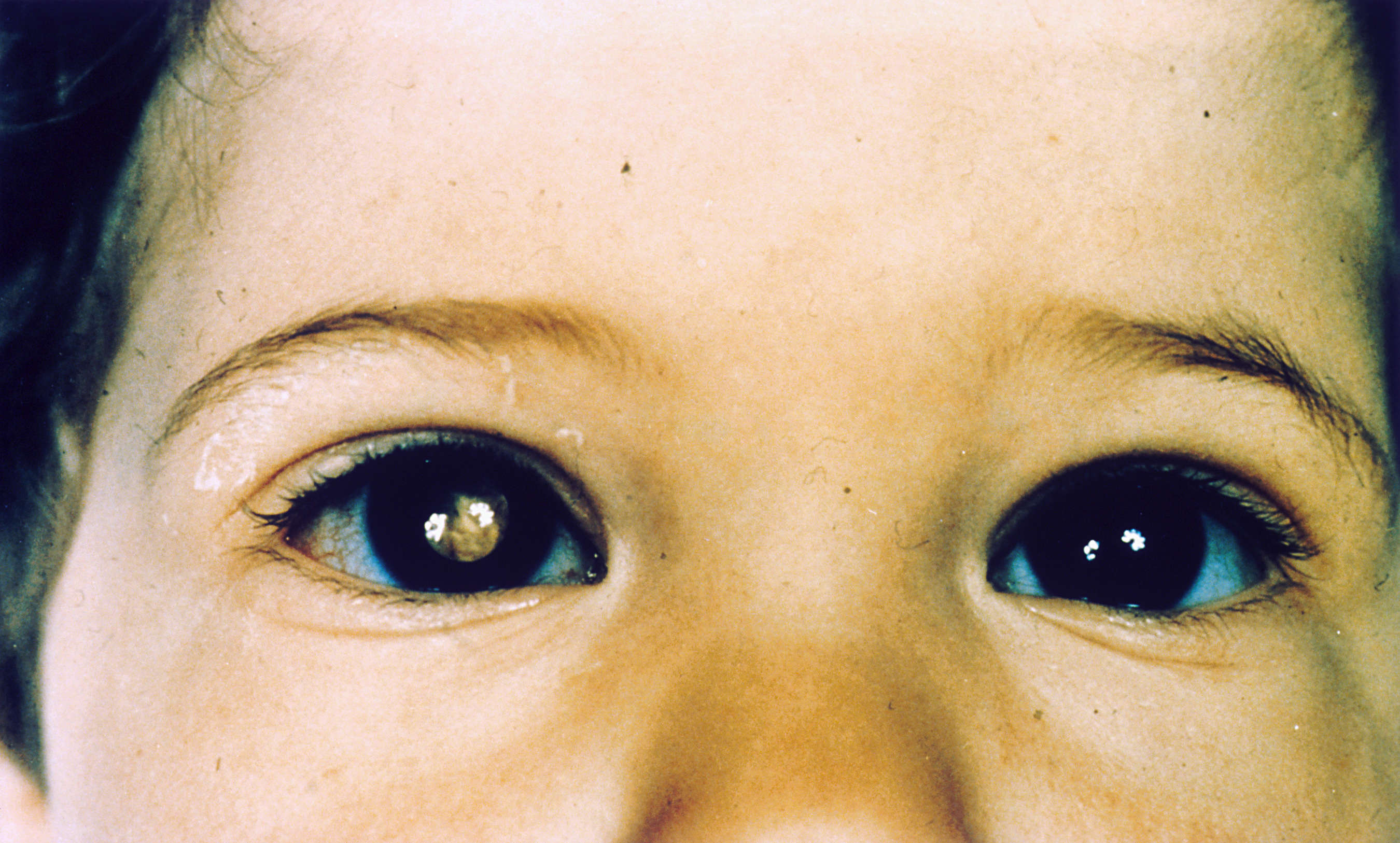 Рак сетчатки глаза у детей: симптомы, лечение, прогноз