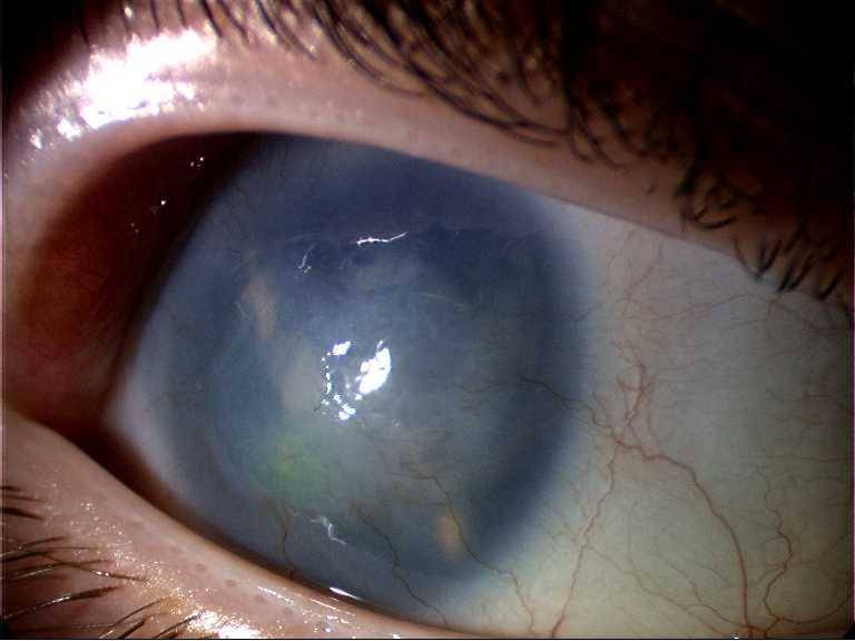 Помутнение роговицы: симптомы и лечение - "здоровое око"
