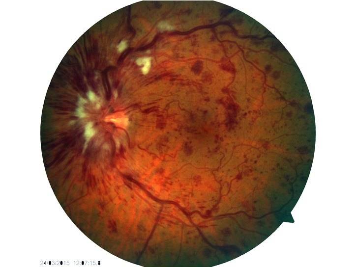 Тромбоз центральной вены сетчатки глаза: лечение и причины