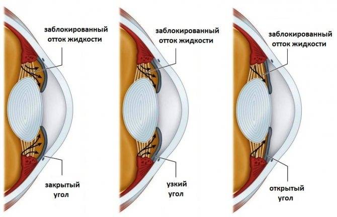 Особенности открытоугольной глаукомы — как избежать потери зрения