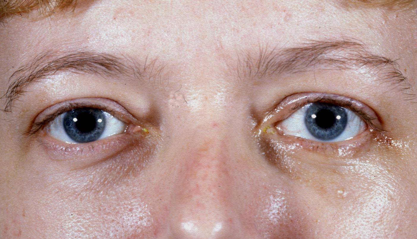 Стеклянные глаза: патология или состояние души