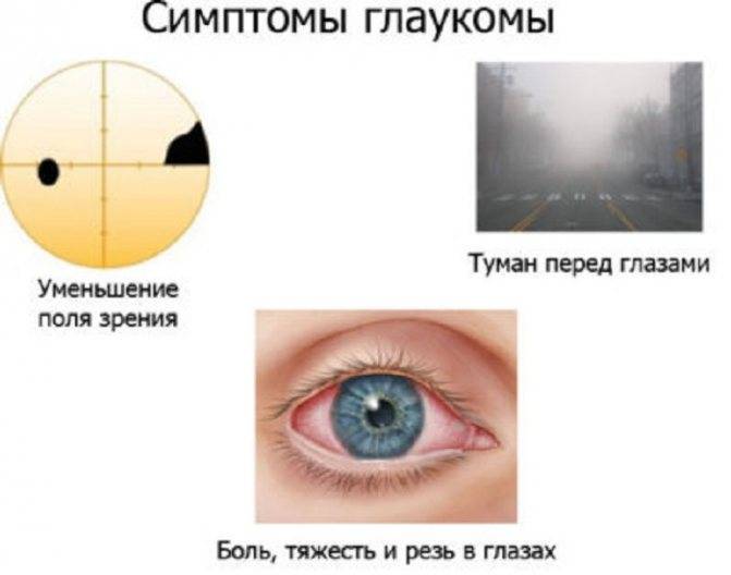 Вторичная глаукома: причины, виды, стимптомы, методы лечения и восстановления зрения