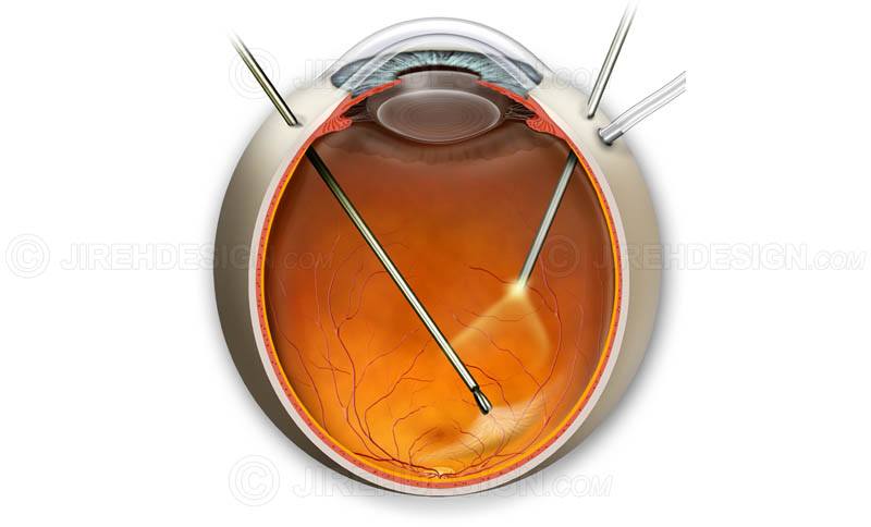 Витрэктомия (операция по удалению стекловидного тела глаза): показания, виды и проведение, рекомендации после