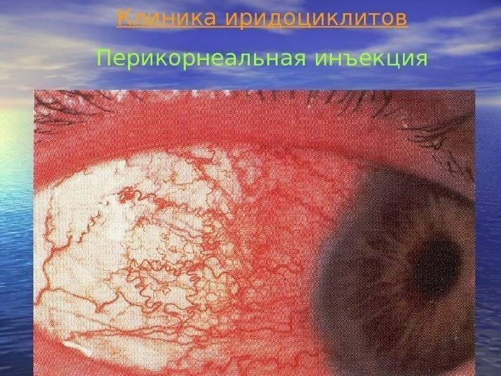 Гиперемия конъюнктивы глазного яблока - виды, причины и лечение. портал "московская офтальмология"