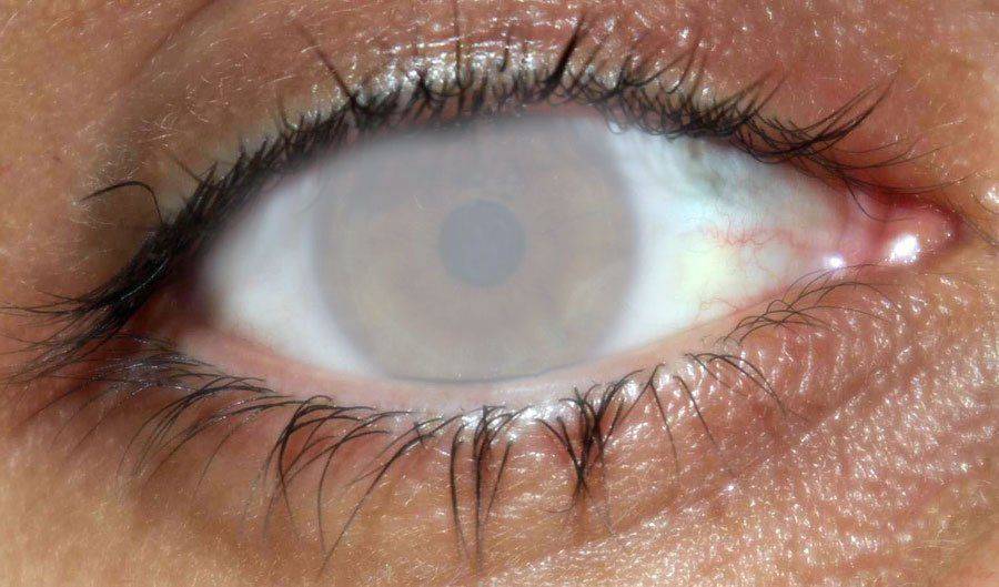 Помутнение роговицы глаза (лейкома, бельмо): разбираемя в причинах и методах терапии