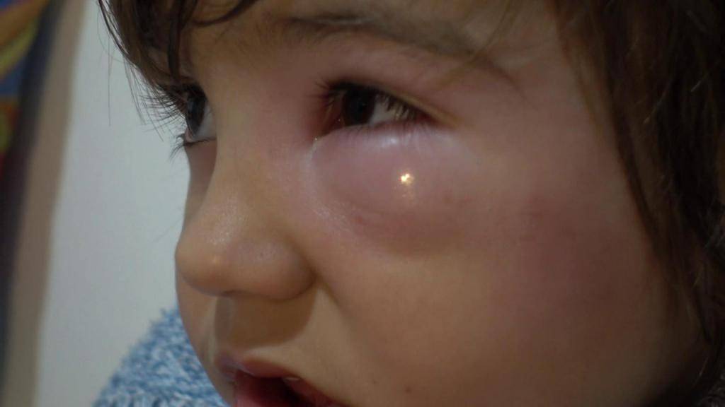 Аллергический отек глаз: причины развития, симптомы и лечение