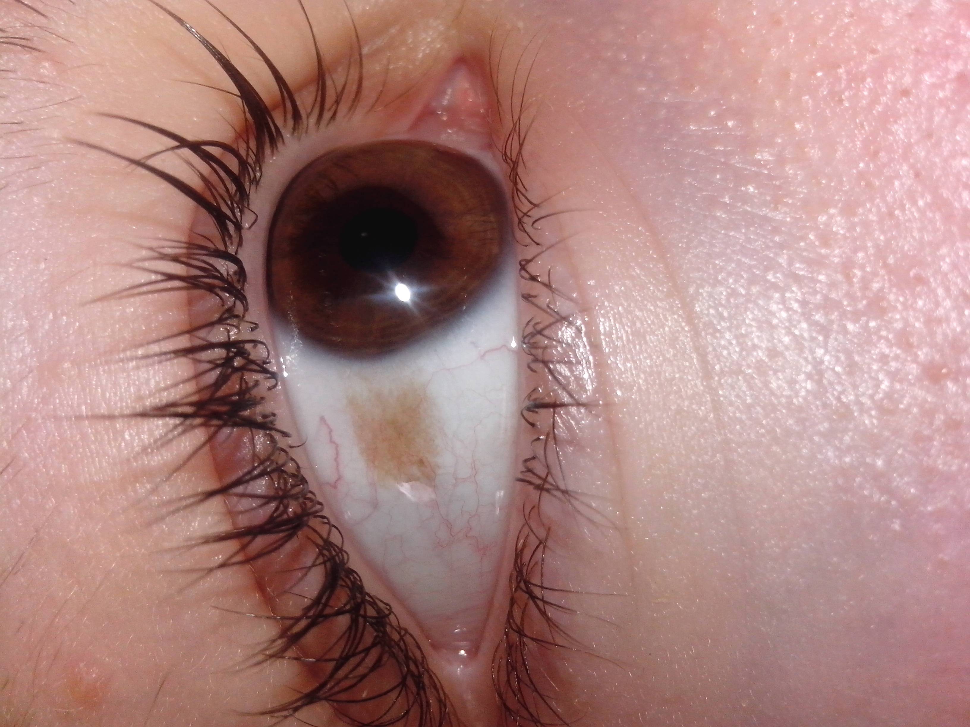 Красное пятно на белке глаза - что это, причины и лечение