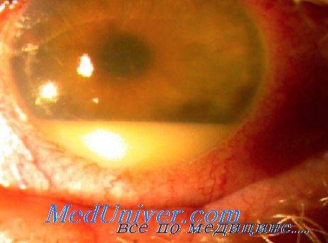 Эндофтальмит: воспаление радужной оболочки глаза - симптомы и лечение гнойного
