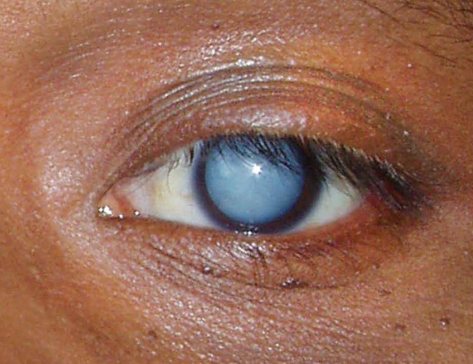 Страшный приговор — лейкома. что такое бельмо на глазу и можно ли это вылечить?