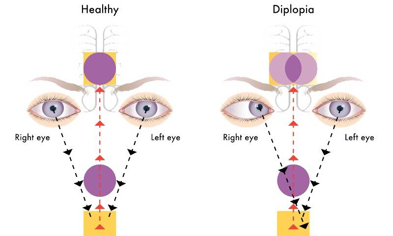 Психосоматика глаз — что означают проблемы со зрением