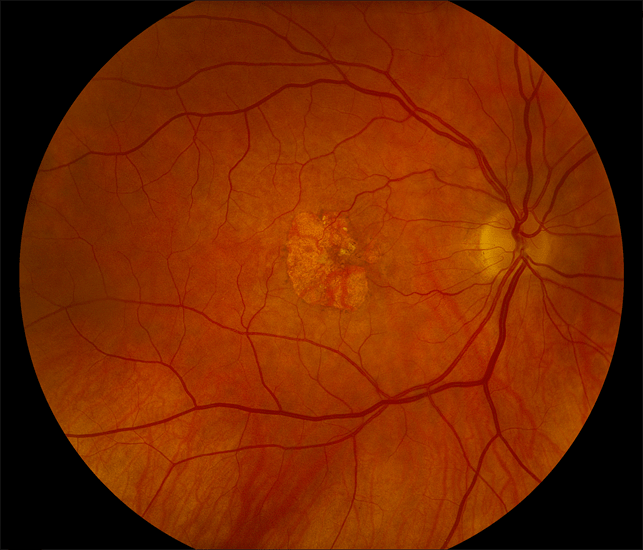 Признаки отслоения сетчатки глаза: симптомы, лечение хирургическим методом — глаза эксперт