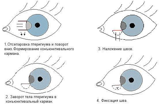 Птеригиум глаза