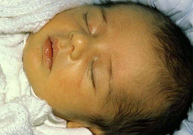 Почему у младенца желтые белки глаз