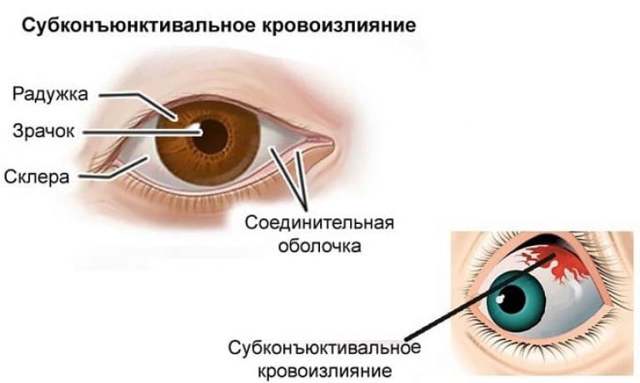 Эффективные глазные капли при кровоизлиянии в глаз