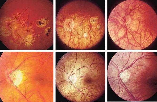 Ангиопатия сетчатки обоих глаз: причины, симптомы и лечение