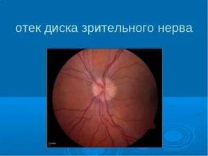 Отек диска зрительного нерва: симптомы, причины и лечение