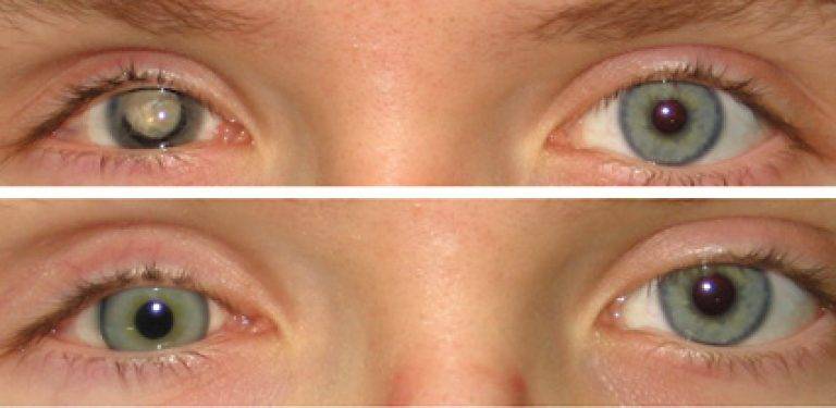 Вредны ли цветные линзы для здоровых глаз