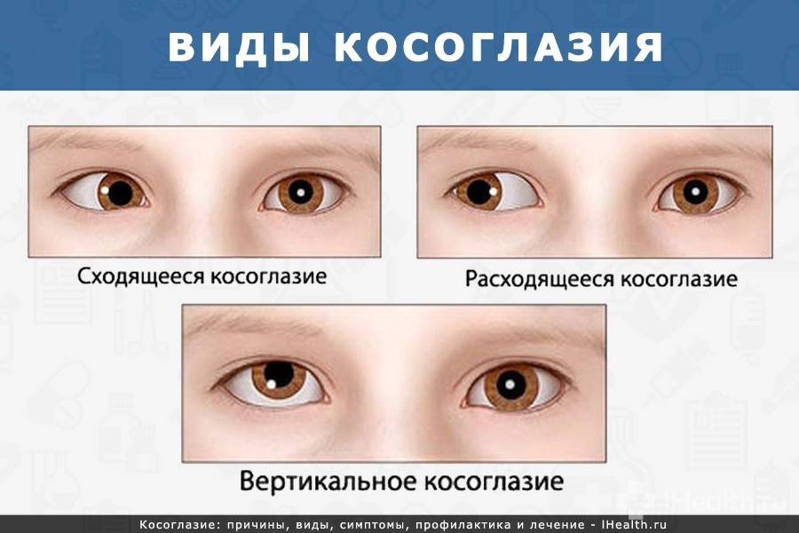 Амблиопия(синдром «ленивого глаза»)-что это за  заболевание — офтальмология
