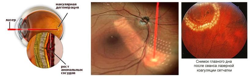 Беременность и лазерная коагуляция сетчатки глаза