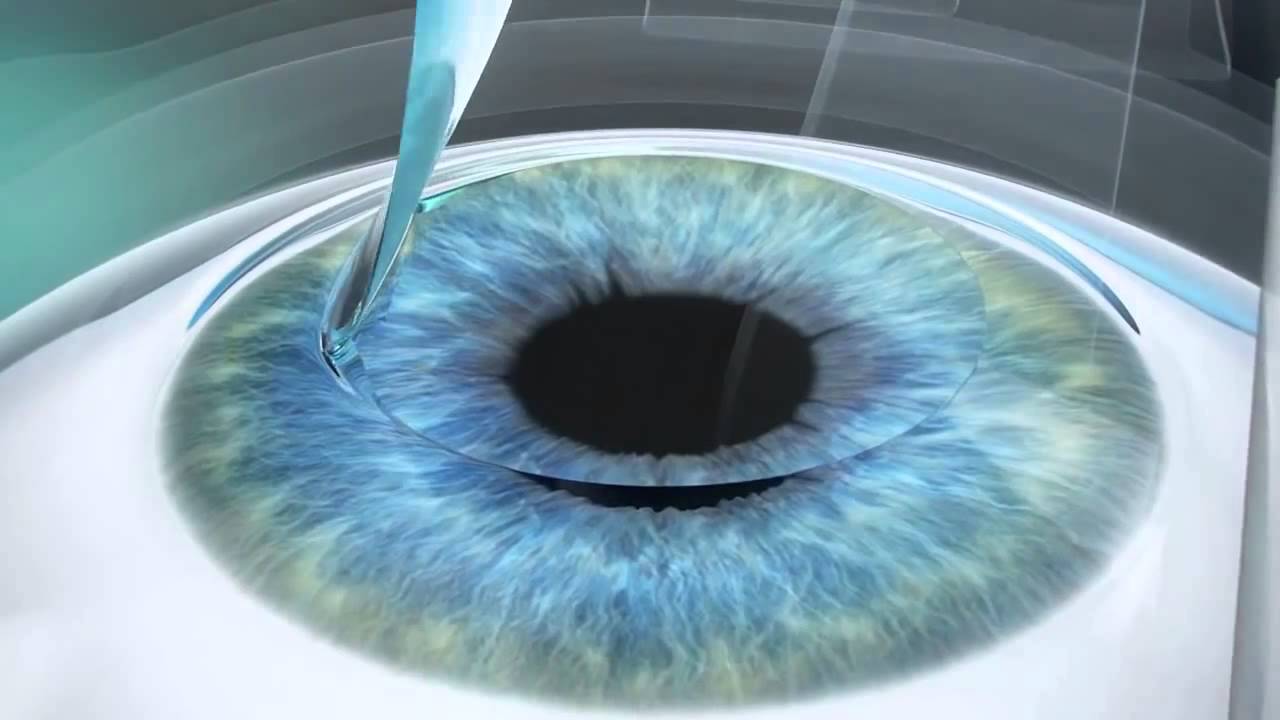 После лазерной коррекции зрения один глаз видит мутно или хуже другого
