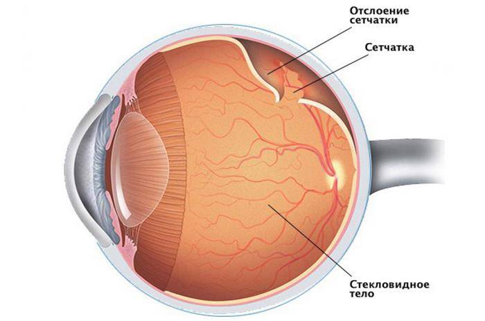Варианты проведения операции на сетчатке глаза