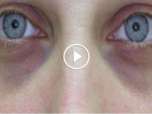 Синяки в уголках глаз у переносицы: причины