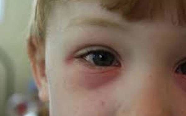 Красные круги под глазами у ребенка: причины появления и методы избавления от проблемы