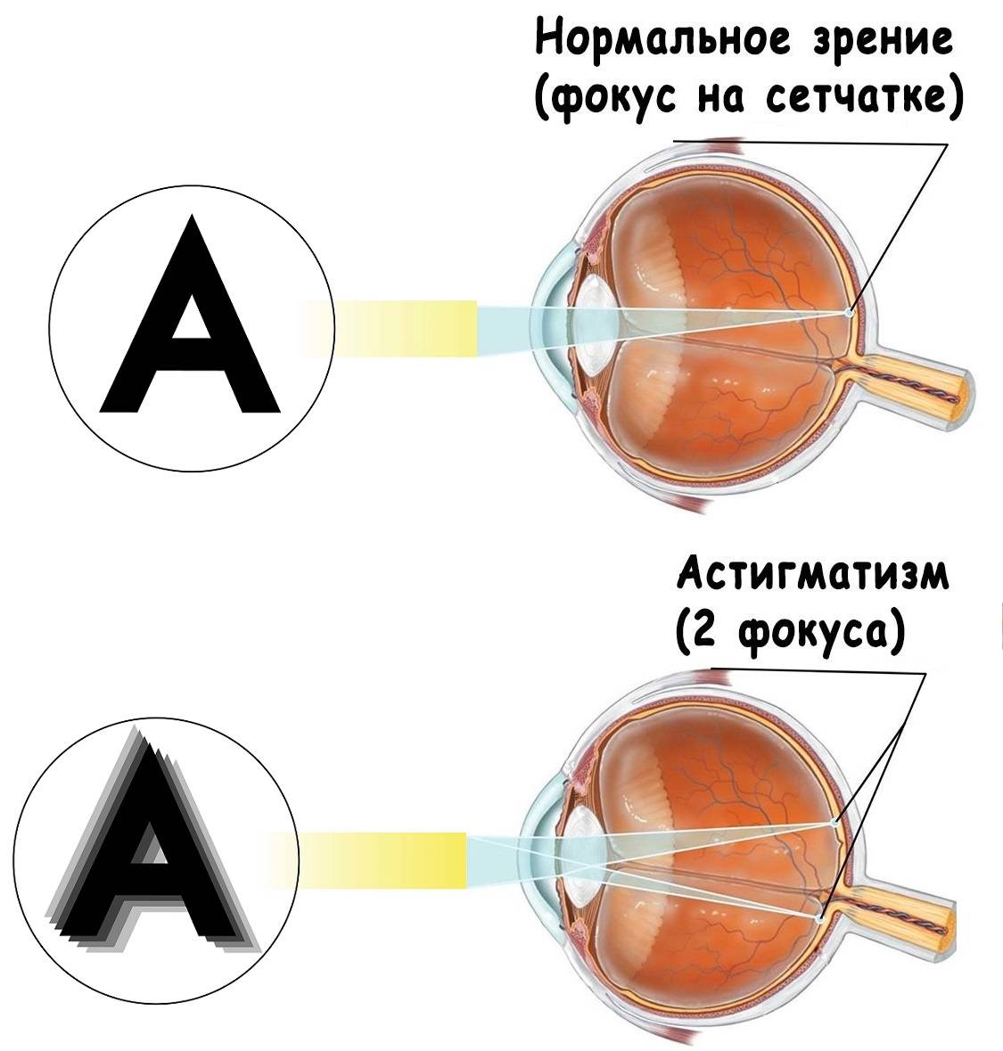 Миопический астигматизм у детей: причины, симптомы и лечение — глаза эксперт