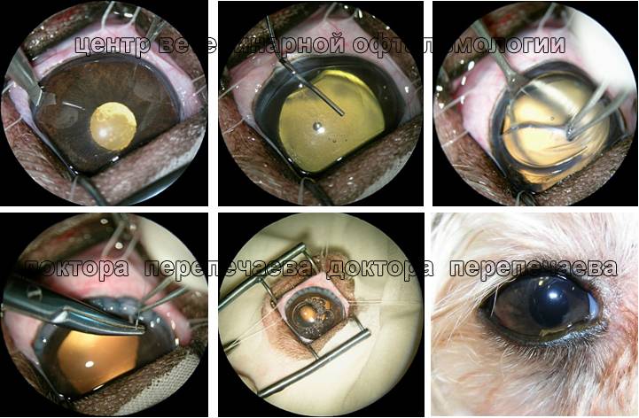 Интракапсулярная экстракция катаракты (иэк): операция, отзывы, клиники, цены