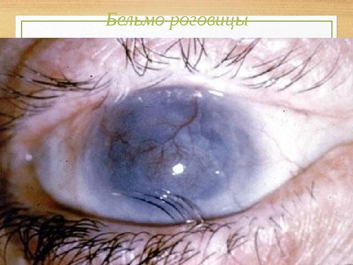 Заболевания глаз. часть 2. заболевания роговицы, хрусталика, стекловидного тела, радужной оболочки и сетчатки