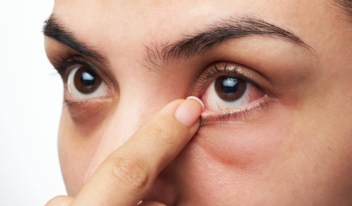 Глаза слезятся и красные: что делать, лечение | компетентно о здоровье на ilive