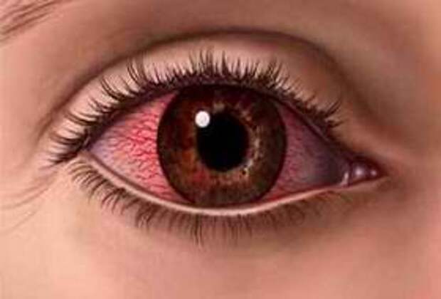 Как убрать красноту глаз: главные причины раздражения