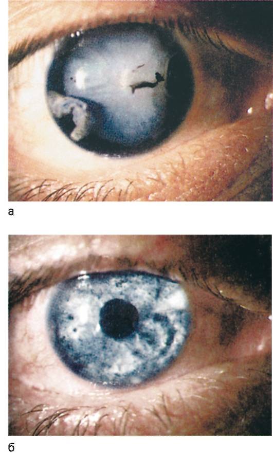 Поликория глаза: что это, причины и лечение двойного зрачка