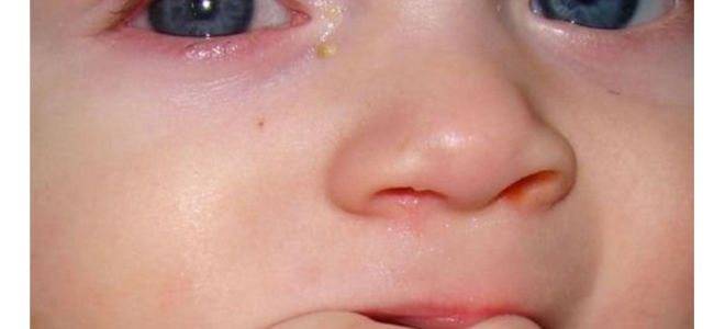 Гноятся глаза и насморк у ребенка, что делать при гное из глаз при насморке?