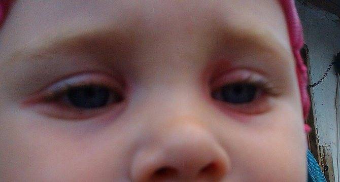 Красный глаз у грудничка, ребенка 6 месяцев, годовалого: причины у грудных детей, что делать, если белок покраснел, слезится