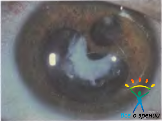 Помутнение задней капсулы хрусталика глаза: причины и лечение (лазерная дисцизия) - moscoweyes.ru - сайт офтальмологического центра "мгк-диагностик"