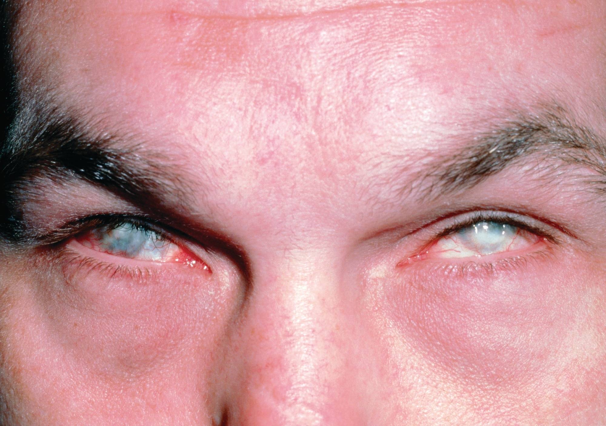 Ожог глаз от сварки: чем лечить?