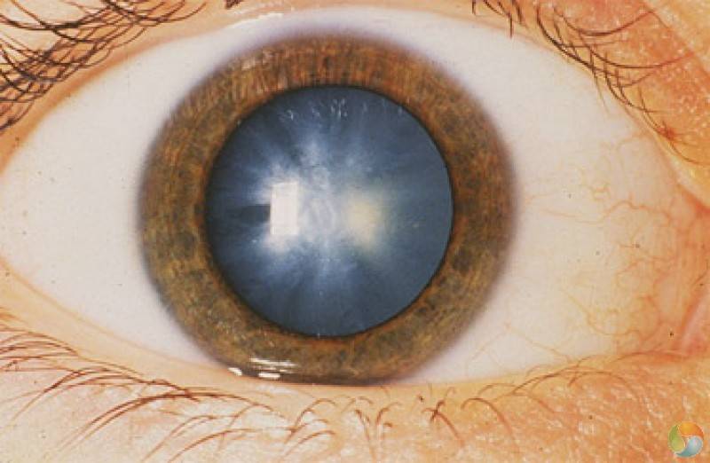 Начальная стадия катаракты: что делать и как остановить развитие