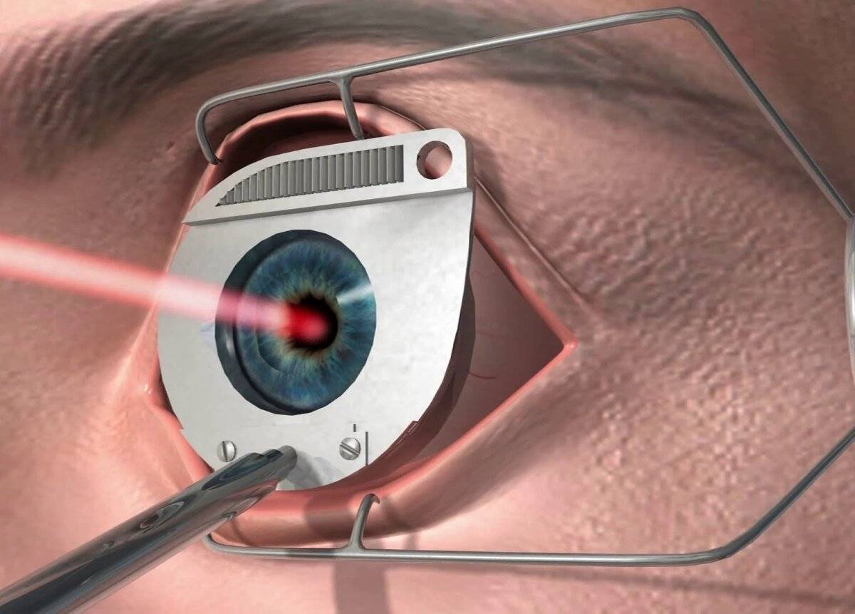 Лечение глаукомы лазером: проведение операции, трабекулопластика