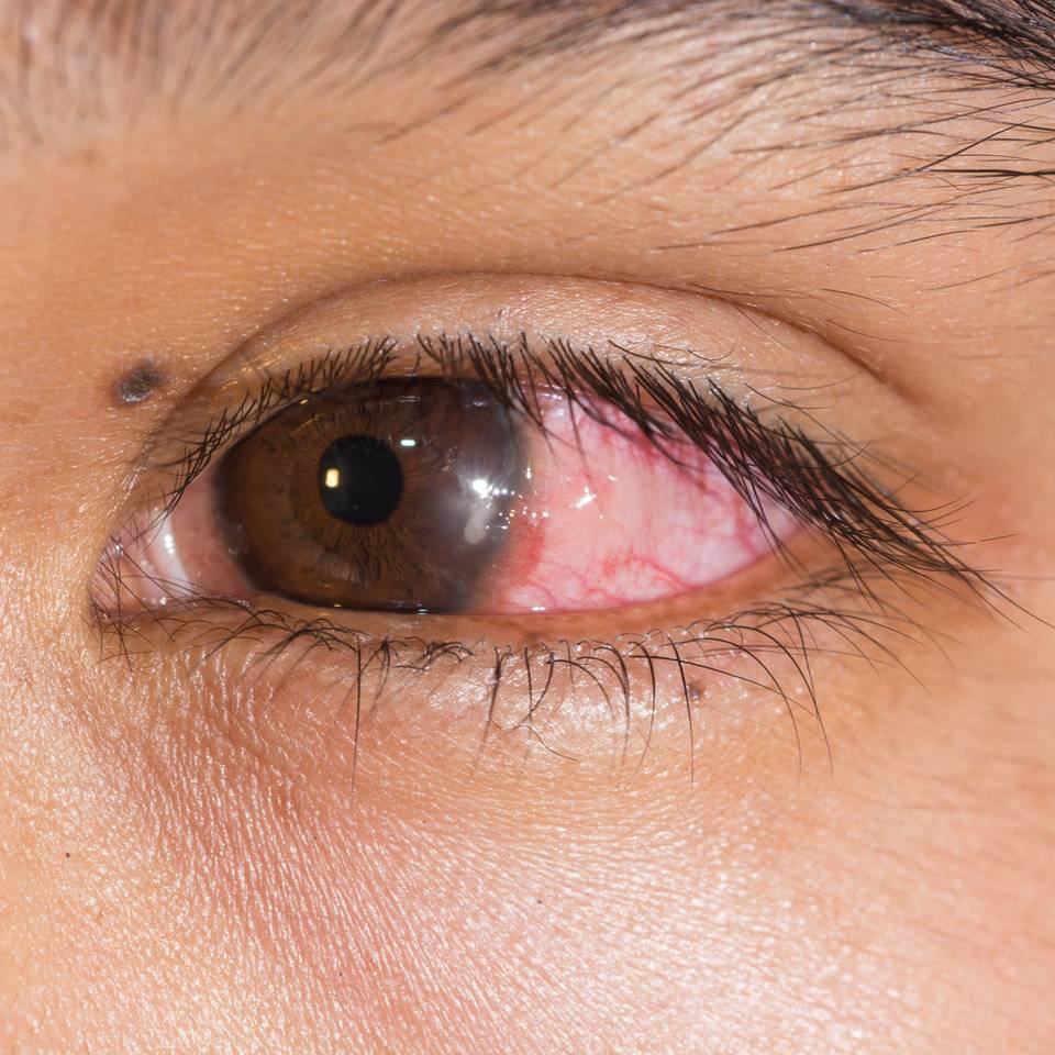 Герпес глаза, симптомы у взрослых, как возникает, лечение