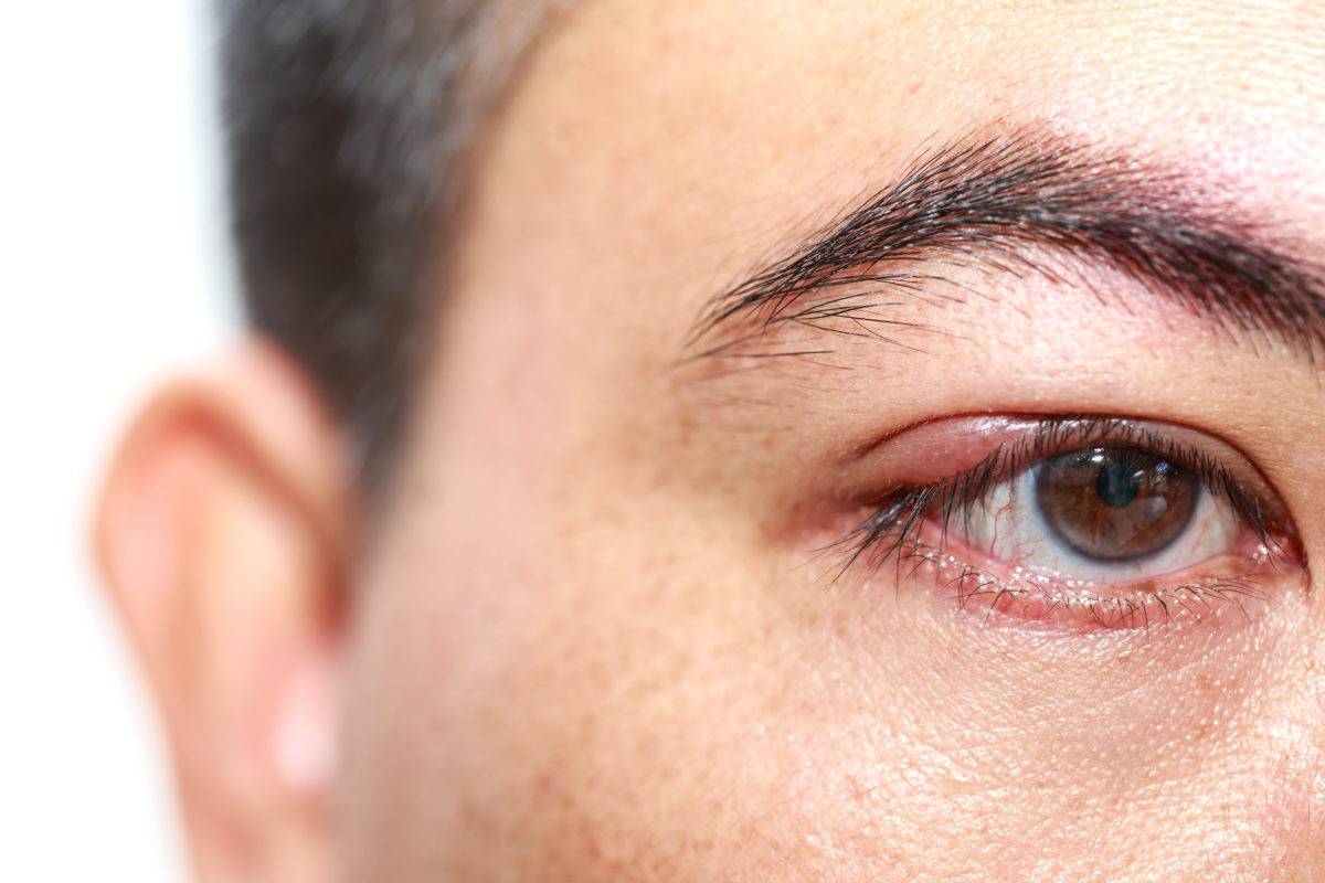 Внутренний ячмень на глазу - причины и лечение