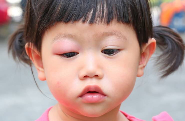 Ячмень на глазу у ребёнка: причины и лечение - "здоровое око"